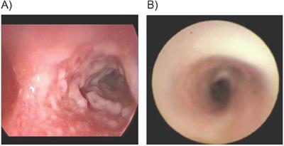 Case Report: Respiratory lesions successfully treated with intravenous plasminogen, human-tvmh, replacement therapy in four patients with plasminogen deficiency type 1